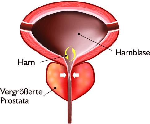 Benigne Prostatahyperplasie (BPH) Benigne Prostatahyperplasie (BPH)