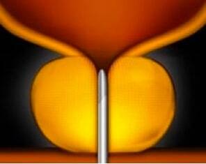 UroLift-System: Schritt 1 UroLift-System: Schritt 1