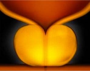 UroLift-System: Vergrößerte Prostata UroLift-System: Vergrößerte Prostata