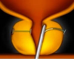 UroLift-System: Schritt 2 UroLift-System: Schritt 2